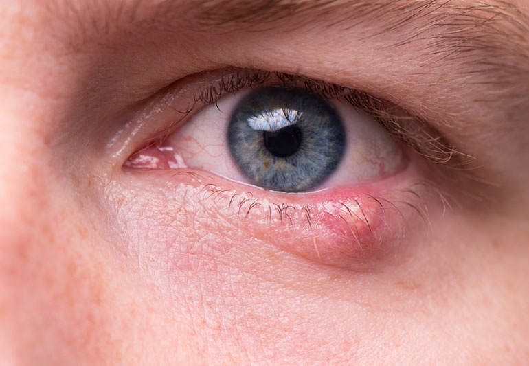 HOW TO GET RID OF A STYE: ALLEVIATING DISCOMFORT AND PROMOTING HEALING