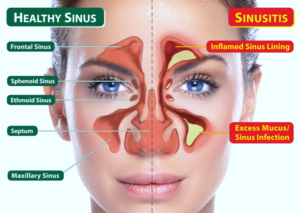Swift Healing: Navigating Swelling and Discomfort After Sinus Surgery