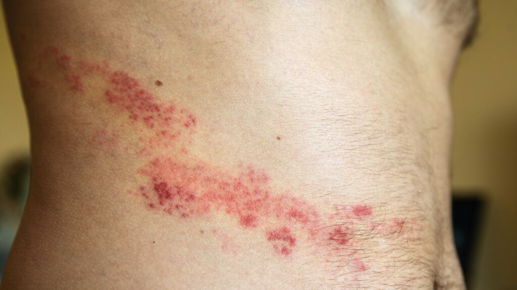 Understanding the Shingles Virus: Causes, Symptoms, and Treatment