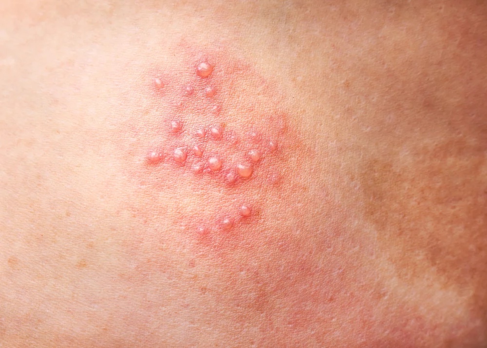 Understanding the Shingles Virus: Causes, Symptoms, and Treatment