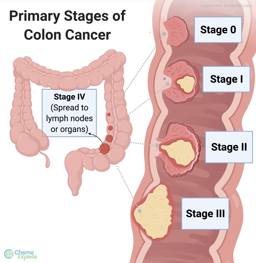 Understanding Colon Cancer: Early Signs, Risk Factors, Screening, and Next Steps