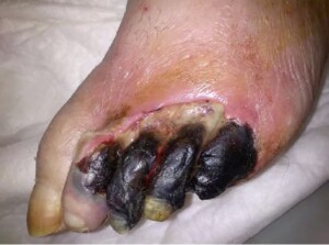Foot Gangrene: Causes, Symptoms, and Treatment