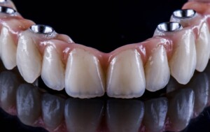 Understanding Full Mouth Dental Bridges: A Comprehensive Guide