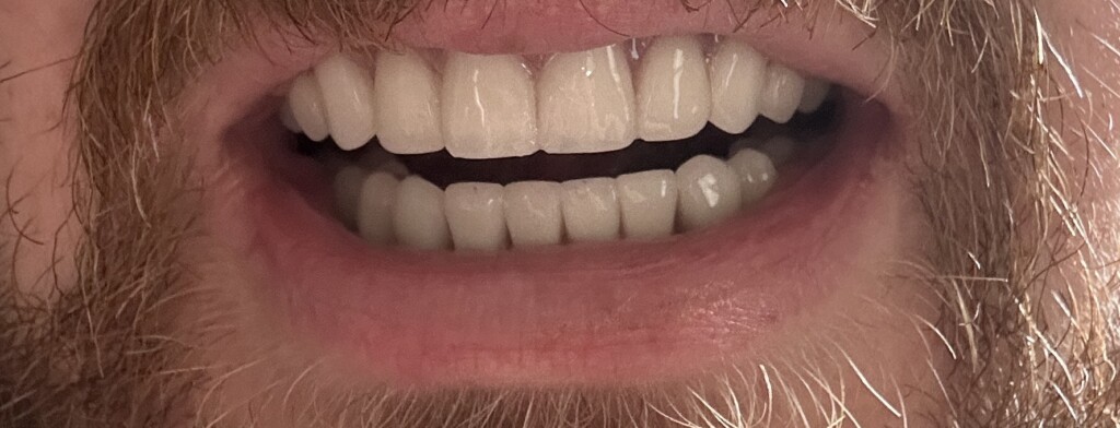 Day 1 with new implant retained bridge in my mouth! Gag!