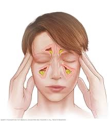 Chronic Bacterial Sphenoid Sinusitis: Solutions and Support