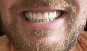 Embracing a New Smile: My Three-Week Journey with Full Mouth Implant Retained Bridges