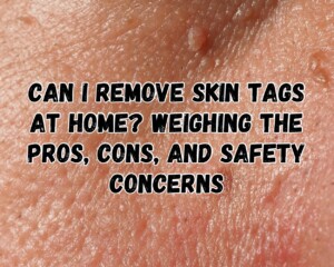Can I Remove Skin Tags at Home? Weighing the Pros, Cons, and Safety Concerns