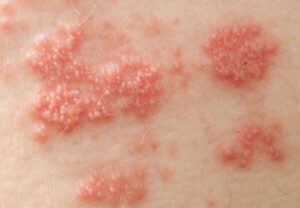 NATURAL REMEDIES AND RELIEF FOR SHINGLES RASH VIRUS