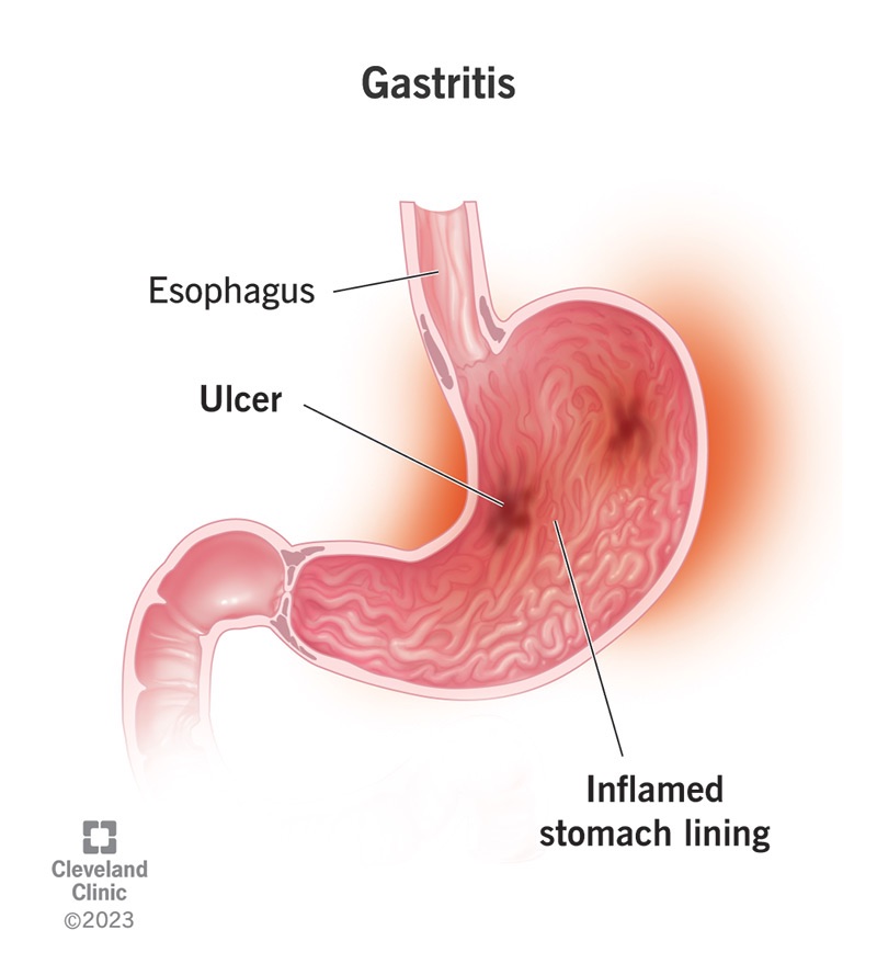 Gastritis: An Inflammation with Far-Reaching Effects