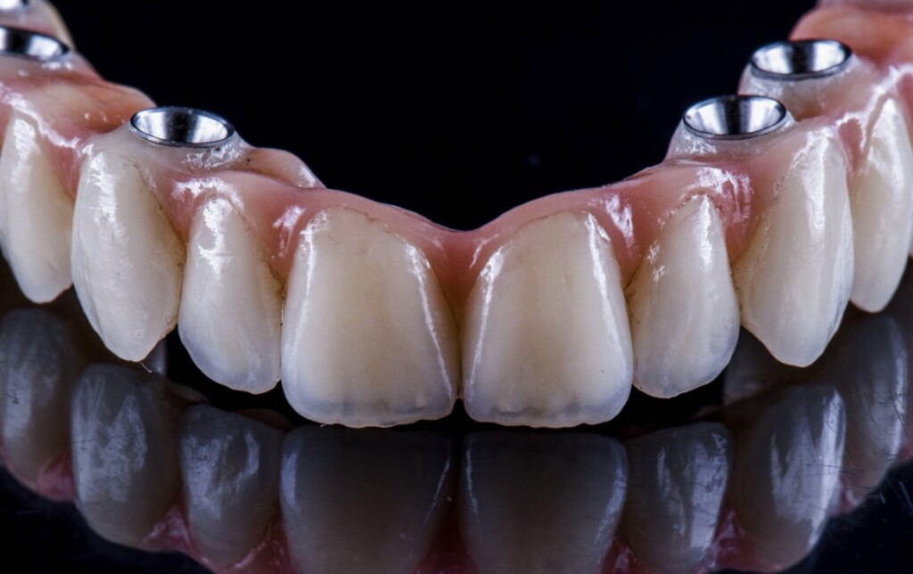 How to Clean and Care for Dental Implants and Bridges