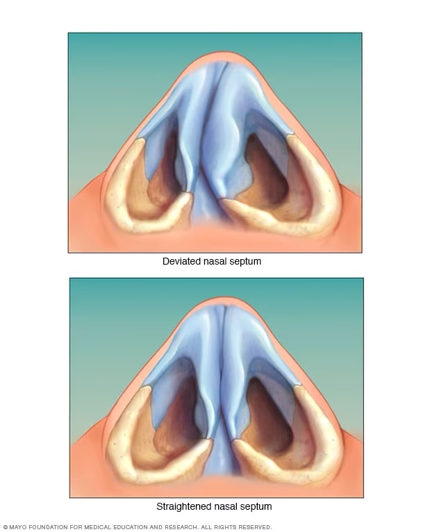 Deviated Septum Surgery Costs: What to Expect