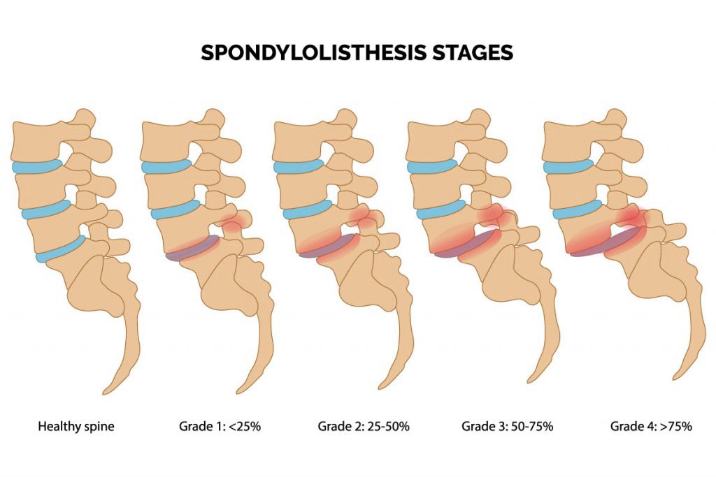 The 5 Types of Spondylolisthesis Explained Simply